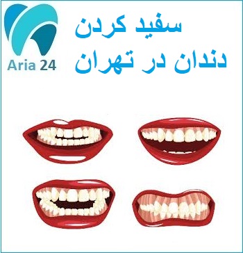 سفید کردن دندان در تهران | مشاوره رایگان ! کلینیک دکتر سید محسنی : 02122366650 - 09221752275
